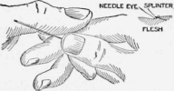 The Eye of a Needle Slipped over a Thorn for Removing It from the Flesh