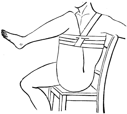 Bleeding From The Thigh Art Femoralis 299 15c
