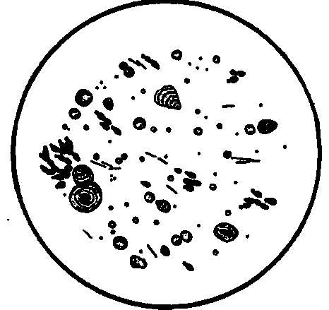 A Specimen of Gastric Contents One Hour after Test Breakfast.