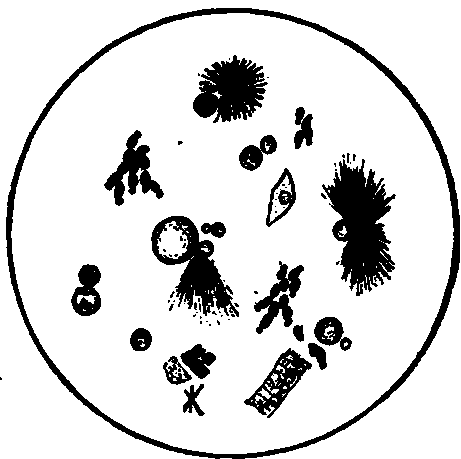 A Specimen of Gastric Contents from Patient with Ischochymla.