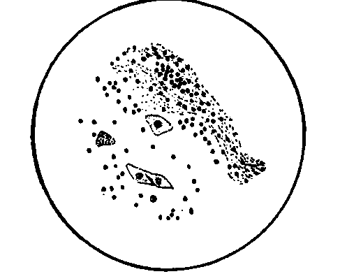 A Specimen of Mucus in the Gastric Juice obtained from a Patient In the Fasting Condition.