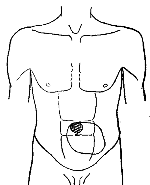 Result of Gastrodiaphany in a Patient with Carcinoma of Stomach.