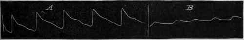 Fig. 120.   Tracings from the radial artery at the wrist : A before and B after the application of a cloth dipped in cold water round the arm. (After Winternitz.