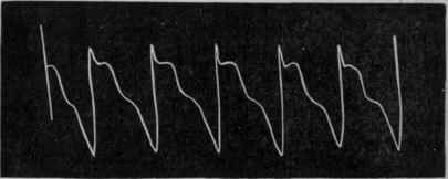 Fig. 173. Normal pulse tracing of a patient suffering from aortic regurgitation and angina pectoris.