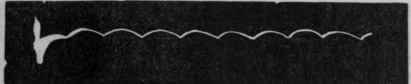 Fig. 174. Tracing of the same pulse during severe anginal pain.