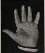 THICK THIRD PHALANGES