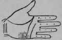 Laryngitis 160
