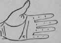 Laryngitis 161