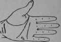 Laryngitis 165