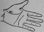 VIII Bars Capillaries And Signs 314