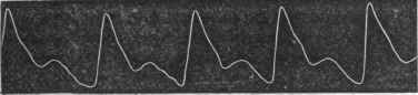 Trace of Dicrotic Pulse in Mania.