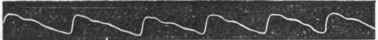 Trace of Pulse in Dementia.