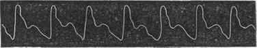Trace of the Radial Pulse under the influence of Increased Temperature.